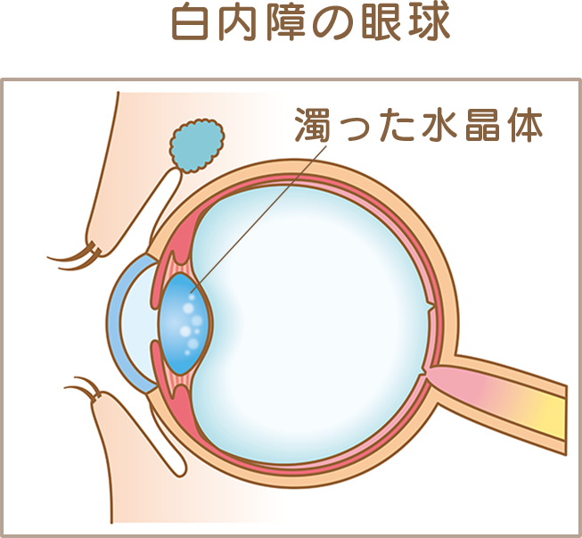 白内障の眼球